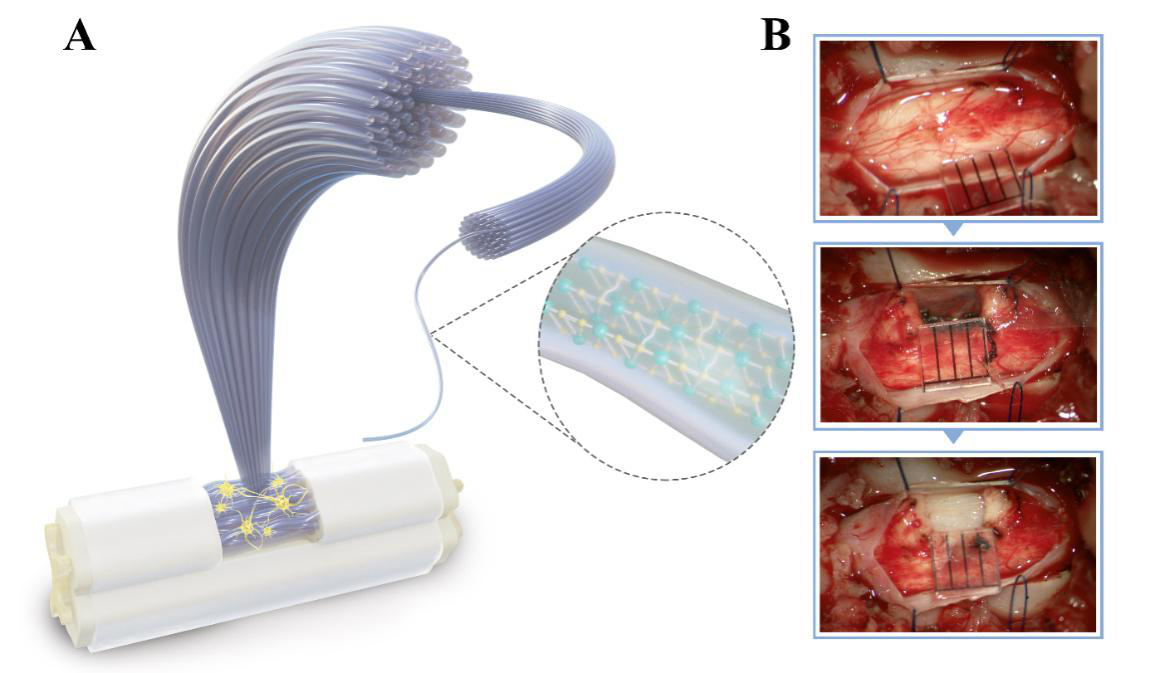 20220531-医院供图-医院供图- 图1 AFG示意图(A)及AFG原位移植术中照片(B)png 20220531-医院供图-医院供图- 图1 AFG示意图(A)及AFG原位移植术中照片(B)png